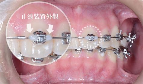 方形矯正線作用|矯正裝置零件介紹